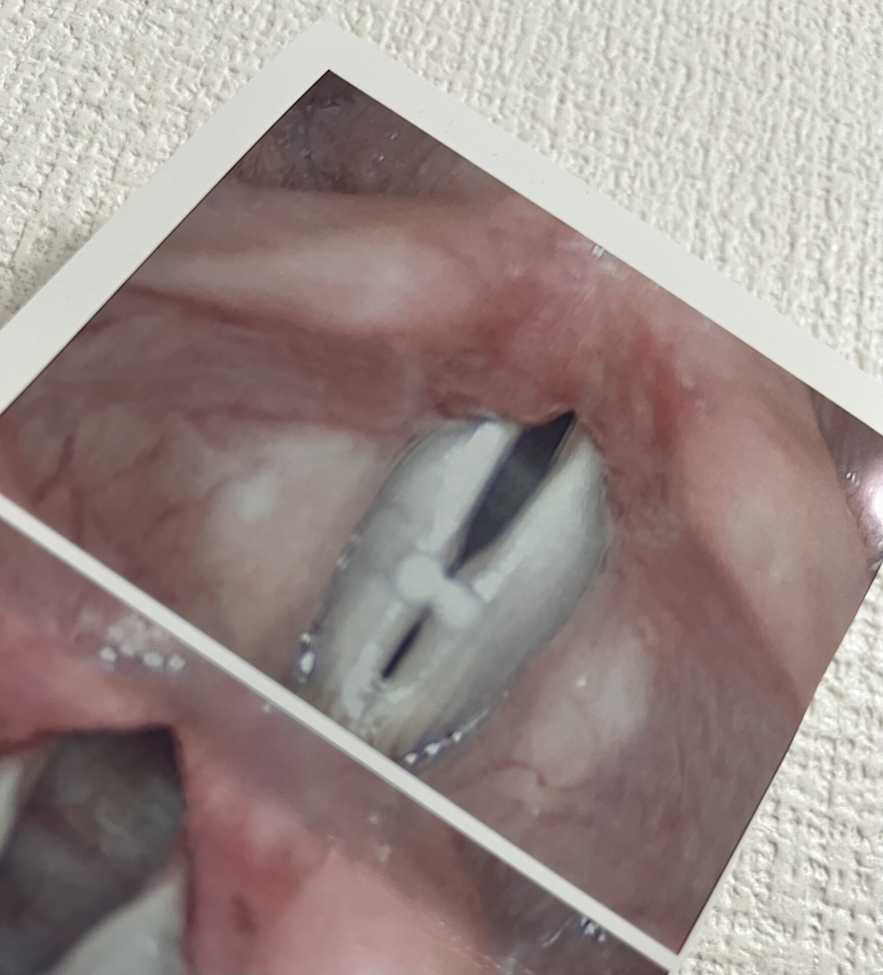 【閲覧注意】しーちゃんの声帯結節